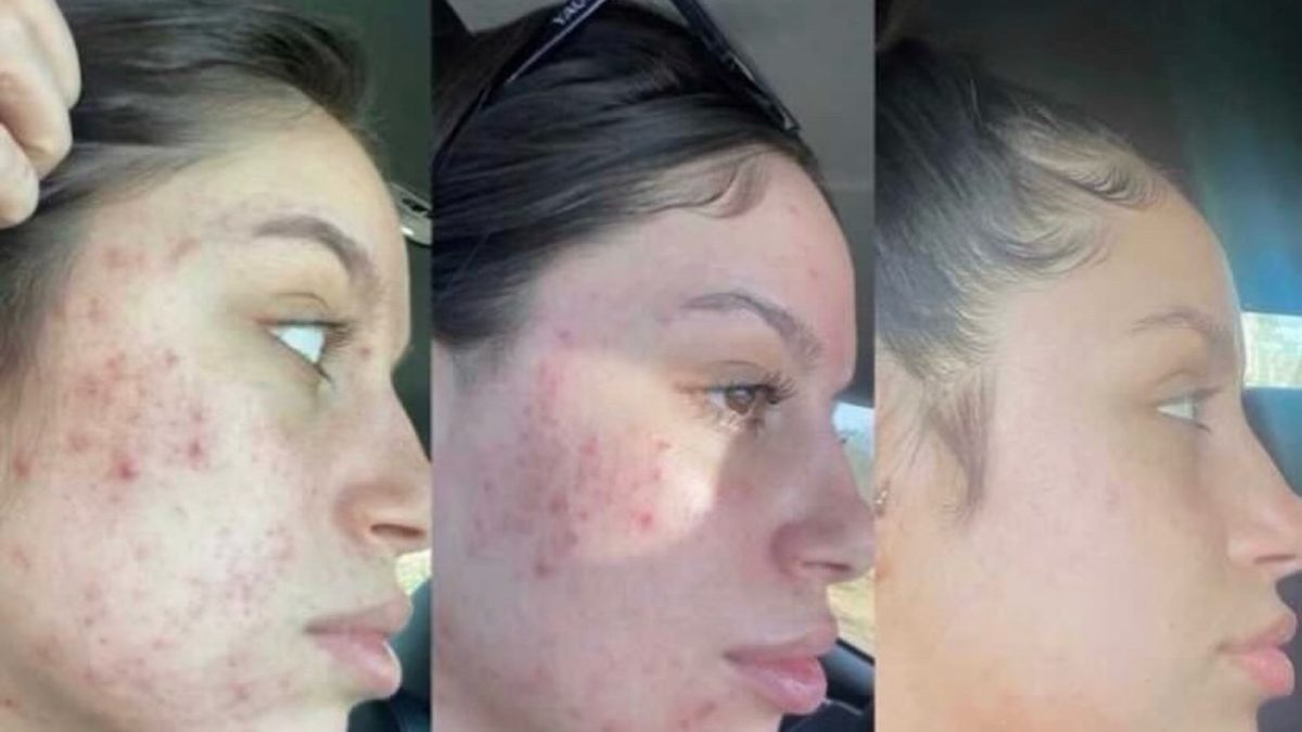 Chemical Peel, Microneedling, and Skincare: before and after, Microneedling at Chin Up Aesthetics