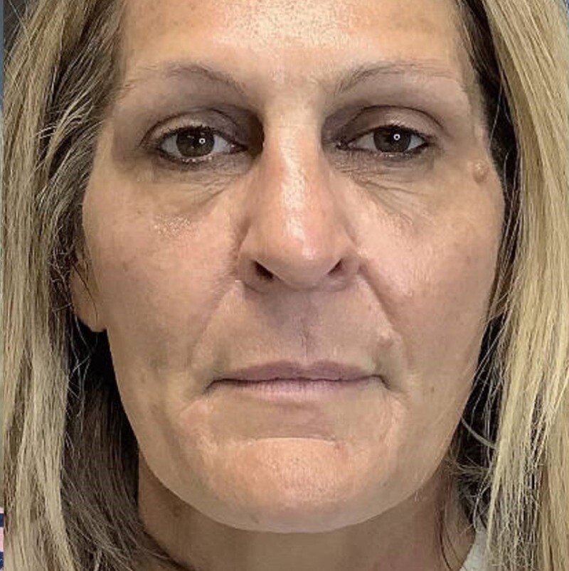 RF Microneedling & Cool Peel (CO2): after at Chin Up Aesthetics