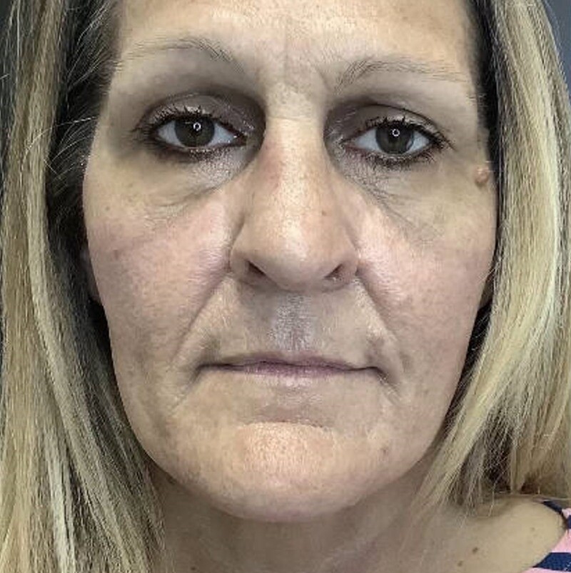 RF Microneedling & Cool Peel (CO2): before at Chin Up Aesthetics