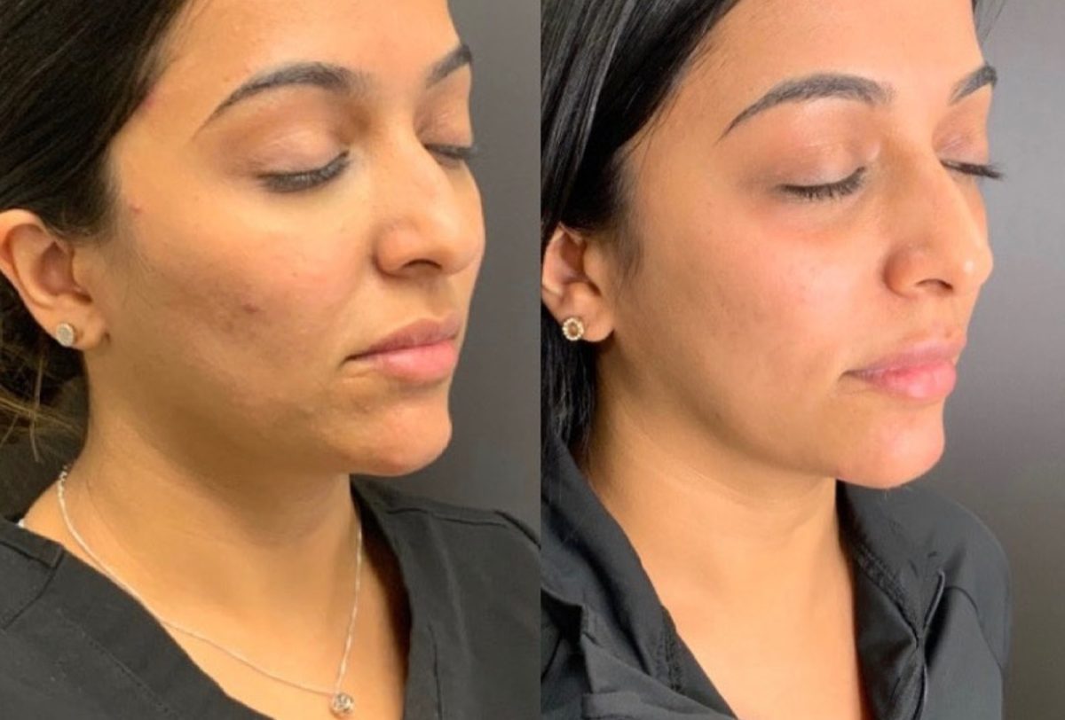 PRP & PDGF: before and after, PRP & PDGF at Chin Up Aesthetics