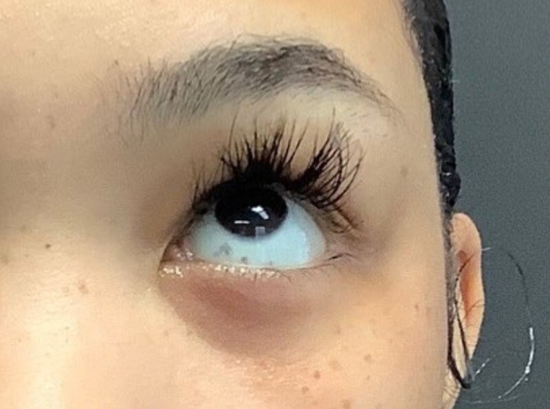PRP & PDGF: before at Chin Up Aesthetics