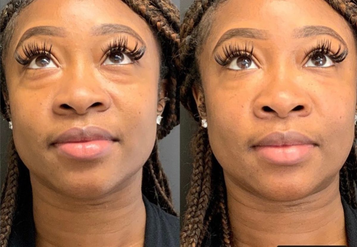 Undereye Correction: before and after, PRP & PDGF at Chin Up Aesthetics