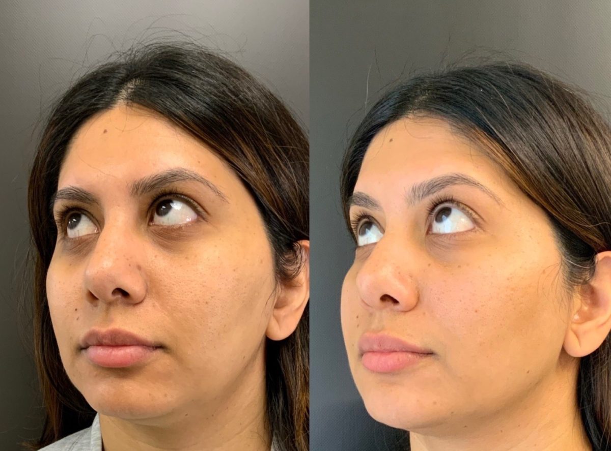 Undereye Correction: before and after, PRP & PDGF at Chin Up Aesthetics
