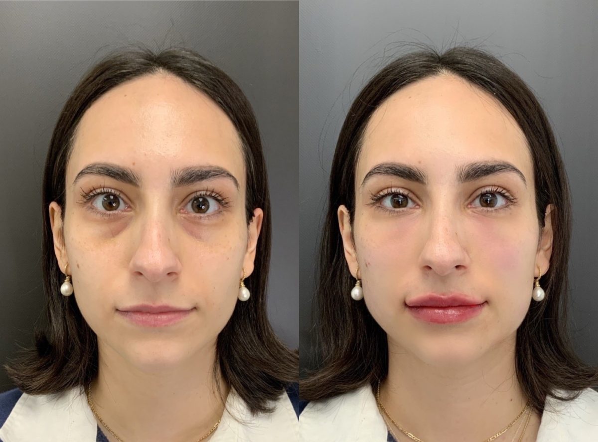 Undereye Correction: before and after, PRP & PDGF at Chin Up Aesthetics