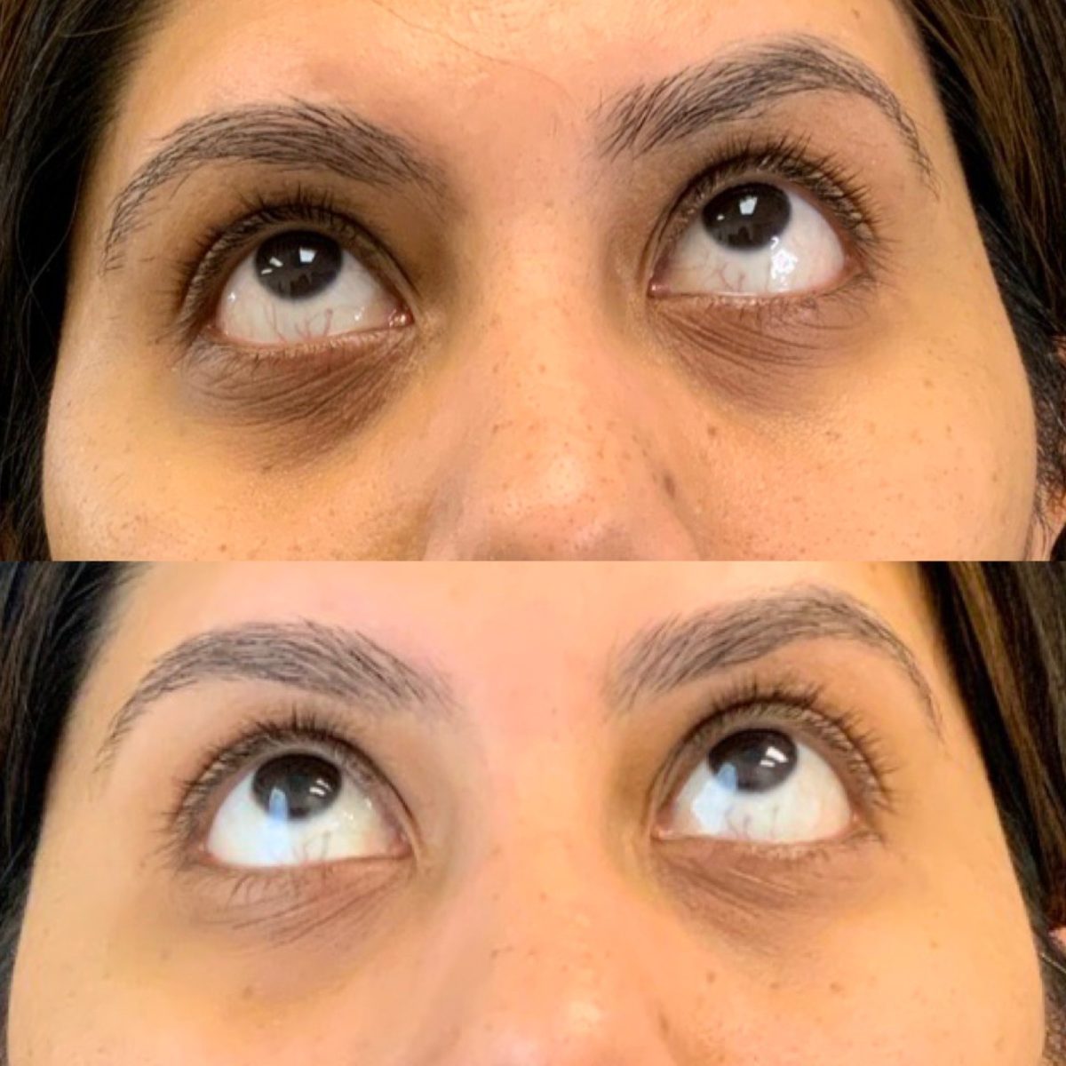 Undereye Correction: before and after, PRP & PDGF at Chin Up Aesthetics