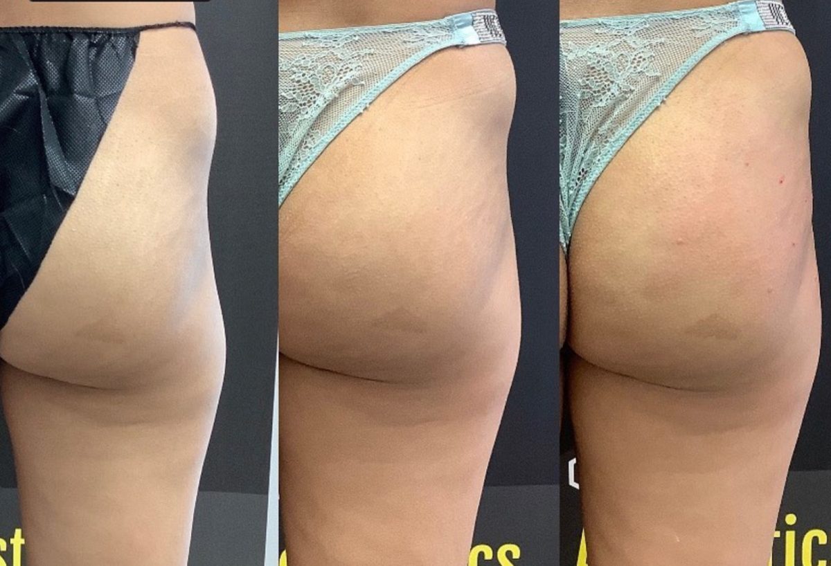Non-Invasive Butt Lift: before and after, Sculptra BBL at Chin Up Aesthetics