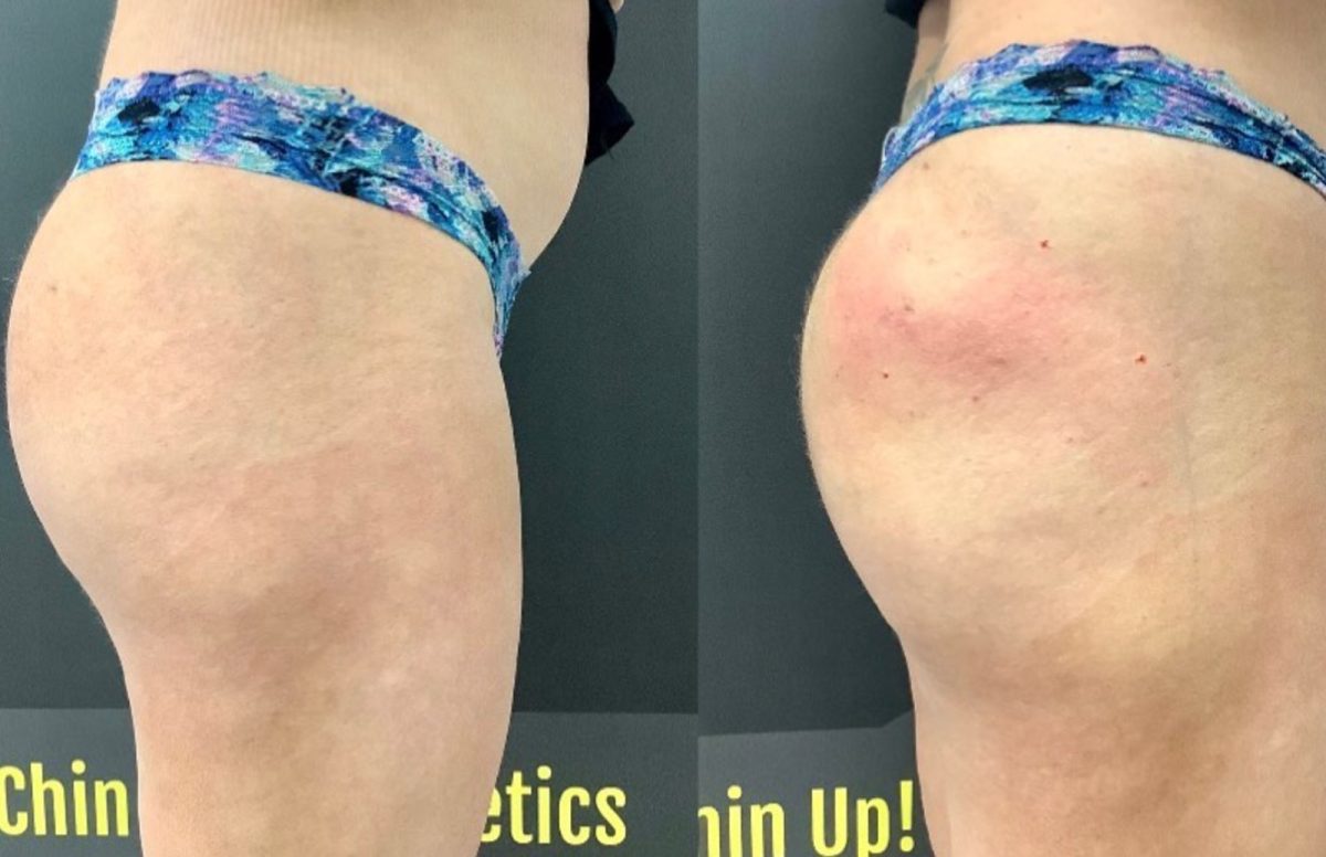 Non-Invasive Butt Lift: before and after, Sculptra BBL at Chin Up Aesthetics