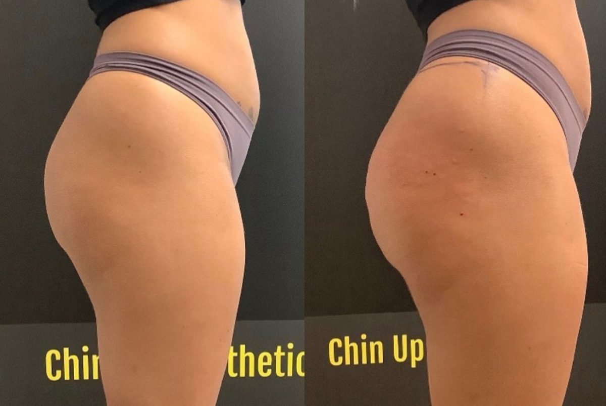 Non-Invasive Butt Lift: before and after, Sculptra BBL at Chin Up Aesthetics