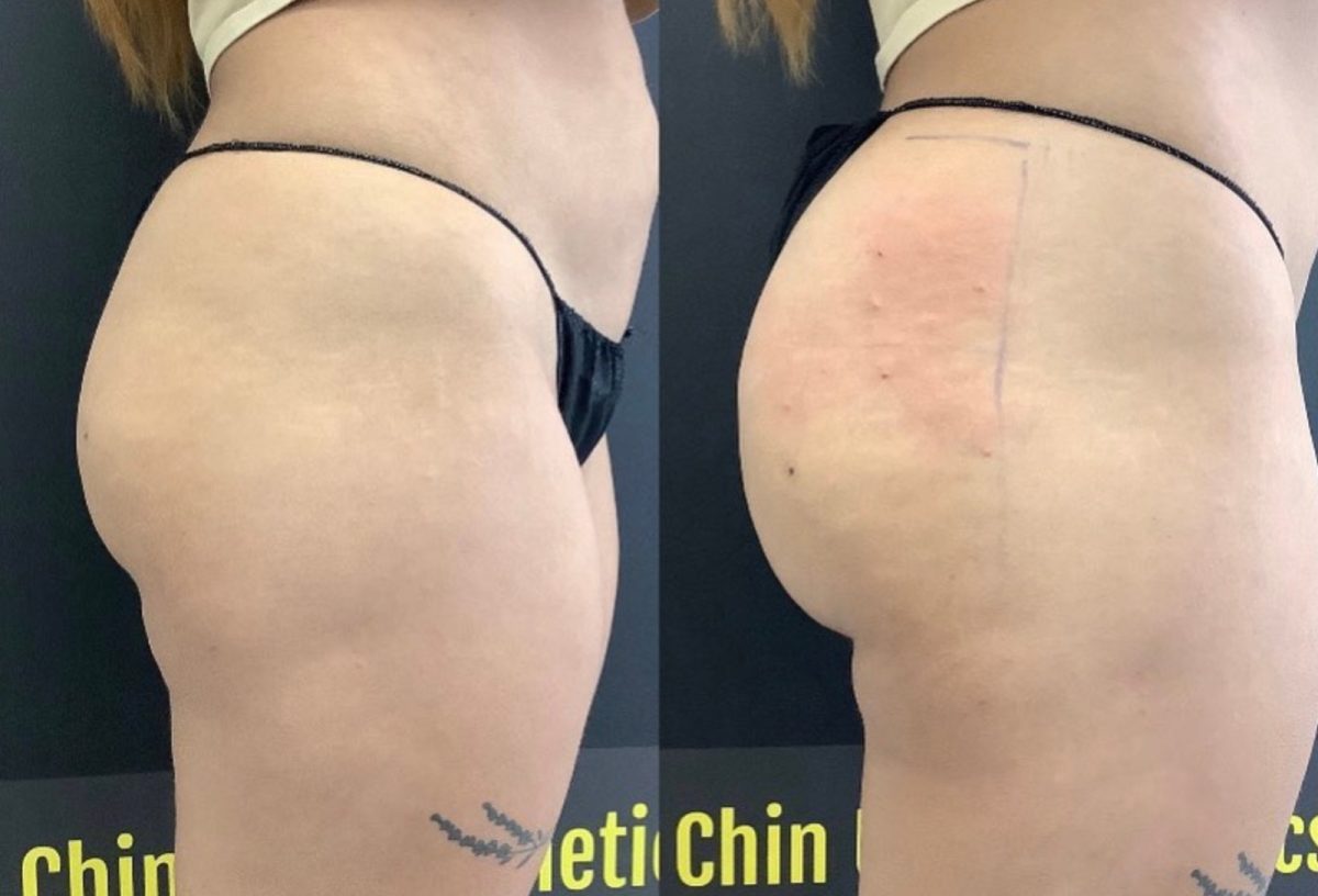 Non-Invasive Butt Lift: before and after, Sculptra BBL at Chin Up Aesthetics