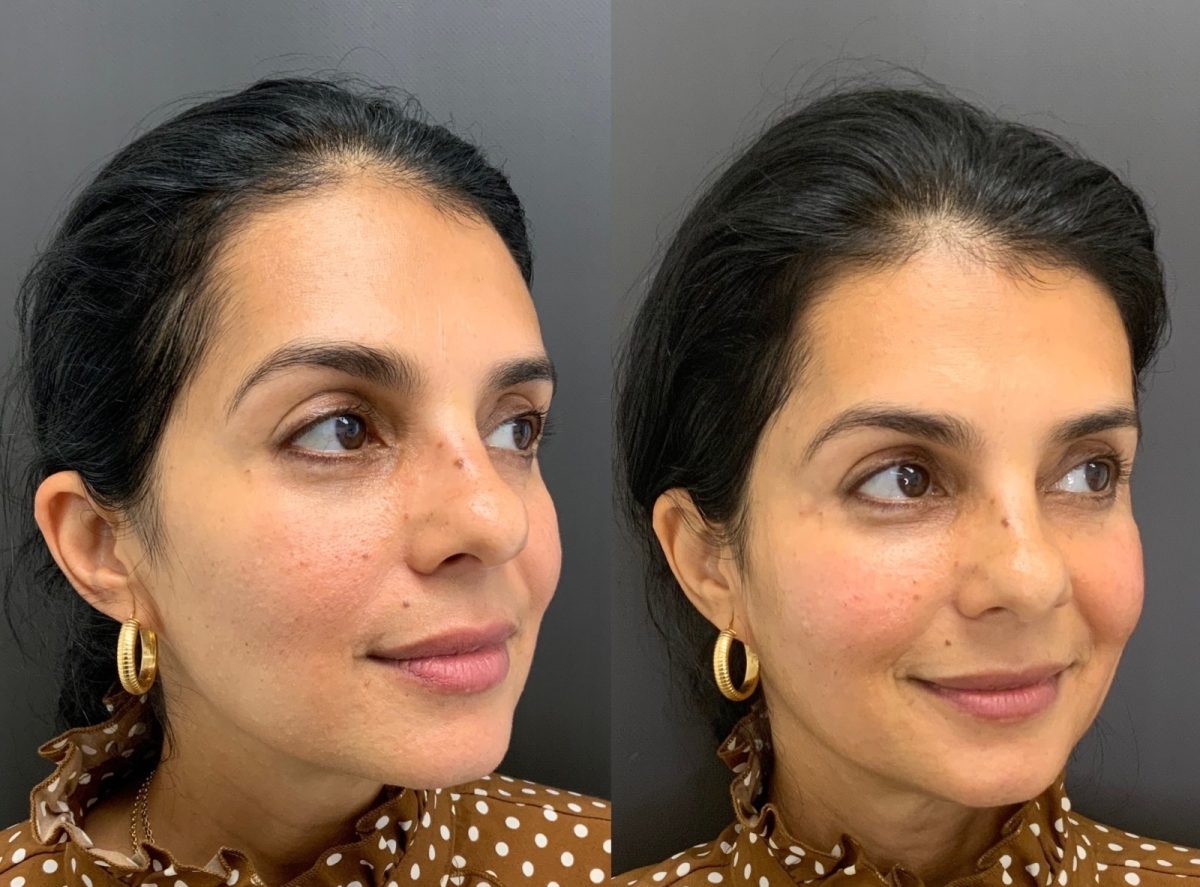 Sculptra: before and after, Sculptra at Chin Up Aesthetics