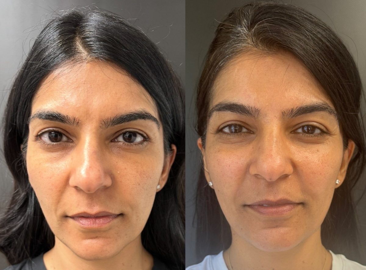Sculptra Face for Collagen Stimulation: before and after, Sculptra at Chin Up Aesthetics