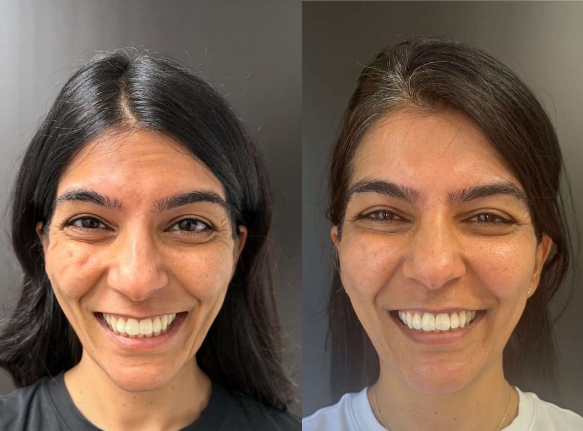 Sculptra Face for Collagen Stimulation: before and after, Sculptra at Chin Up Aesthetics