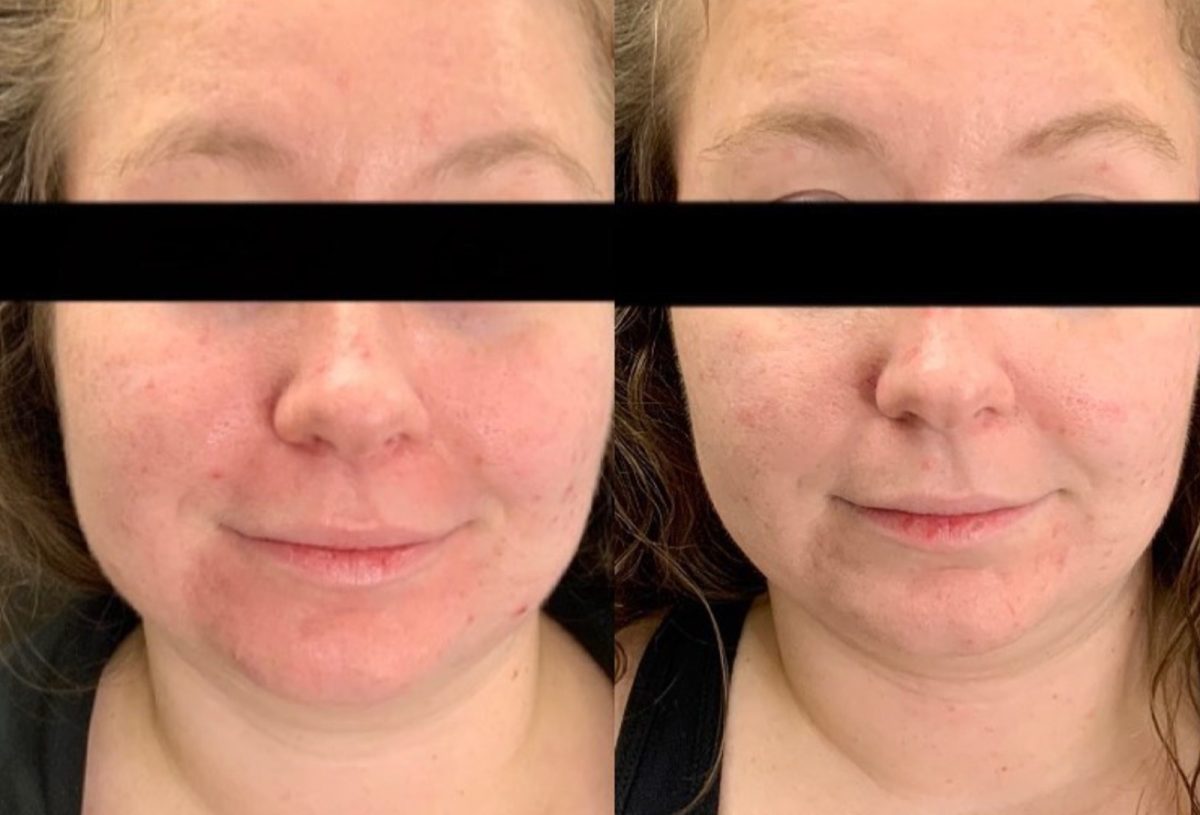 Chemical Peel: before and after, Skincare & Acne at Chin Up Aesthetics