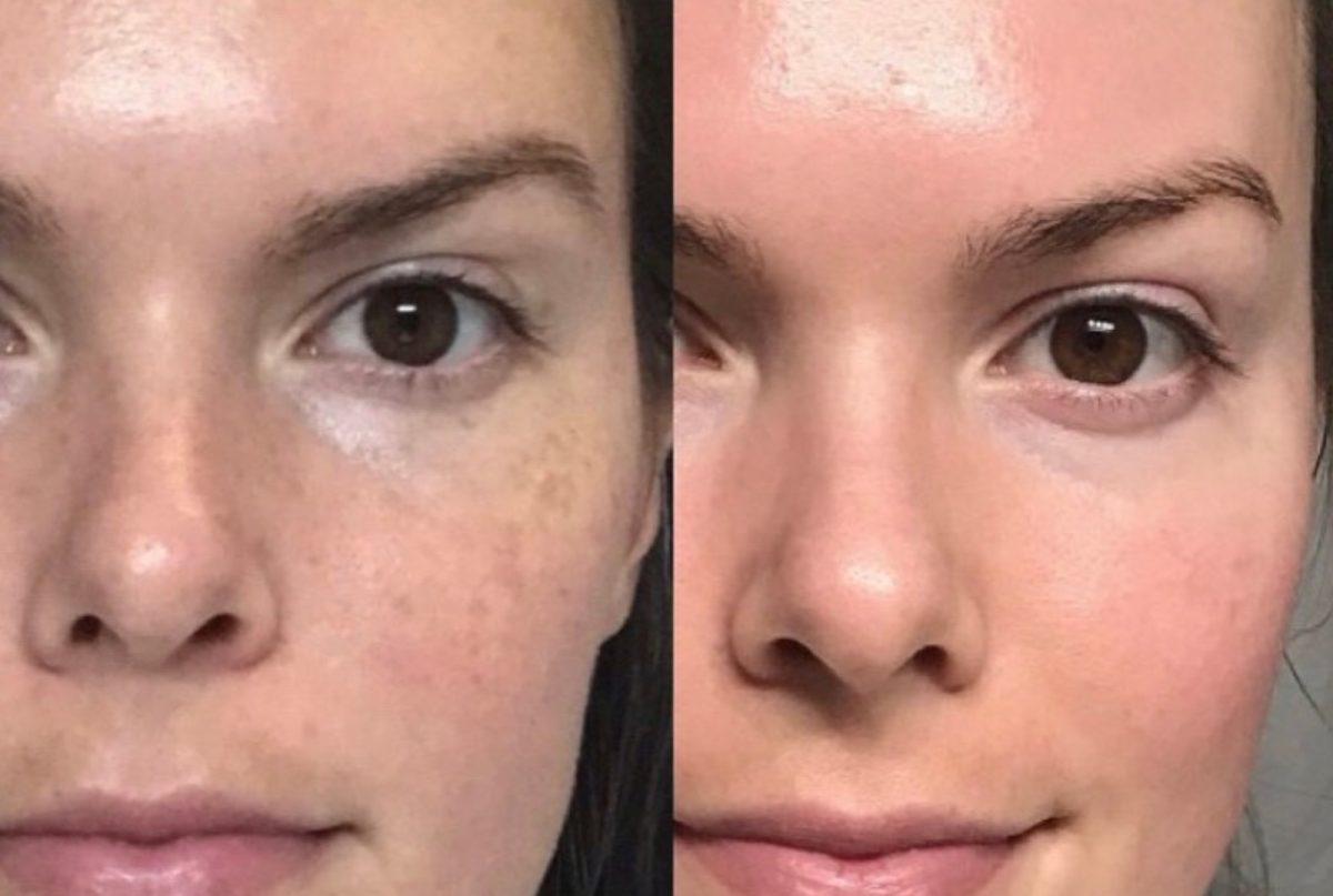 Cool Peel (CO2): before and after, Skincare & Acne at Chin Up Aesthetics