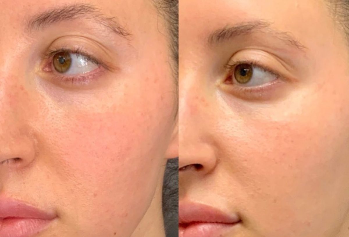 Cool Peel (CO2): before and after, Skincare & Acne at Chin Up Aesthetics