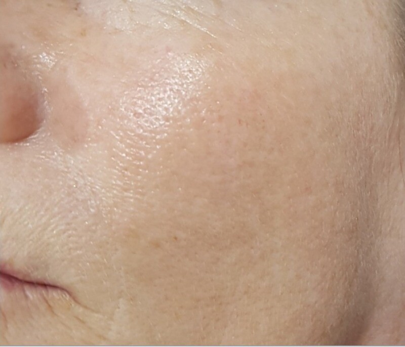 Cool Peel (CO2 Laser): after at Chin Up Aesthetics