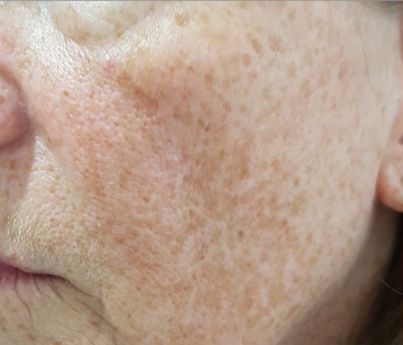 Cool Peel (CO2 Laser): before at Chin Up Aesthetics