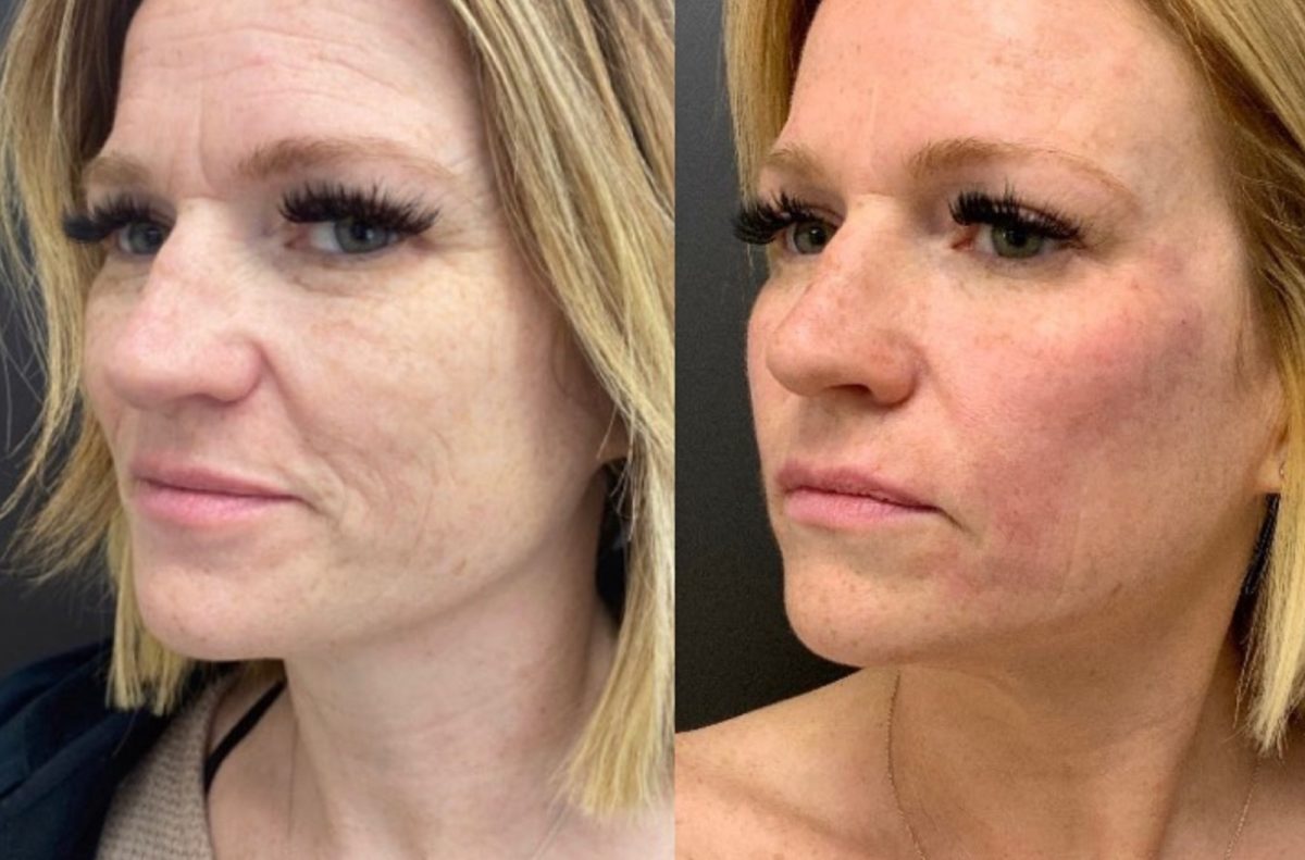 Cool Peel (CO2) & Microneedling: before and after, Skincare & Acne at Chin Up Aesthetics