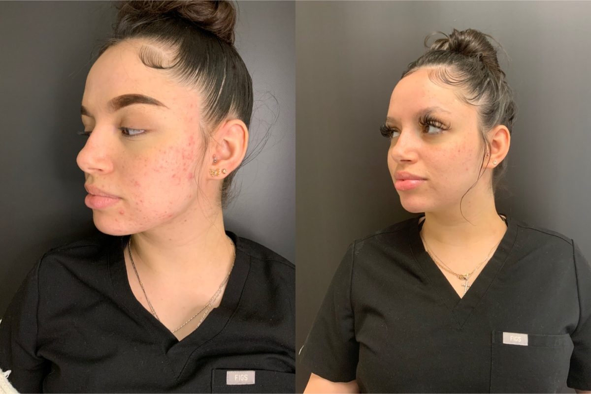 Microneedling, Chemical Peel, & Skinbetter: before and after, Skincare & Acne at Chin Up Aesthetics