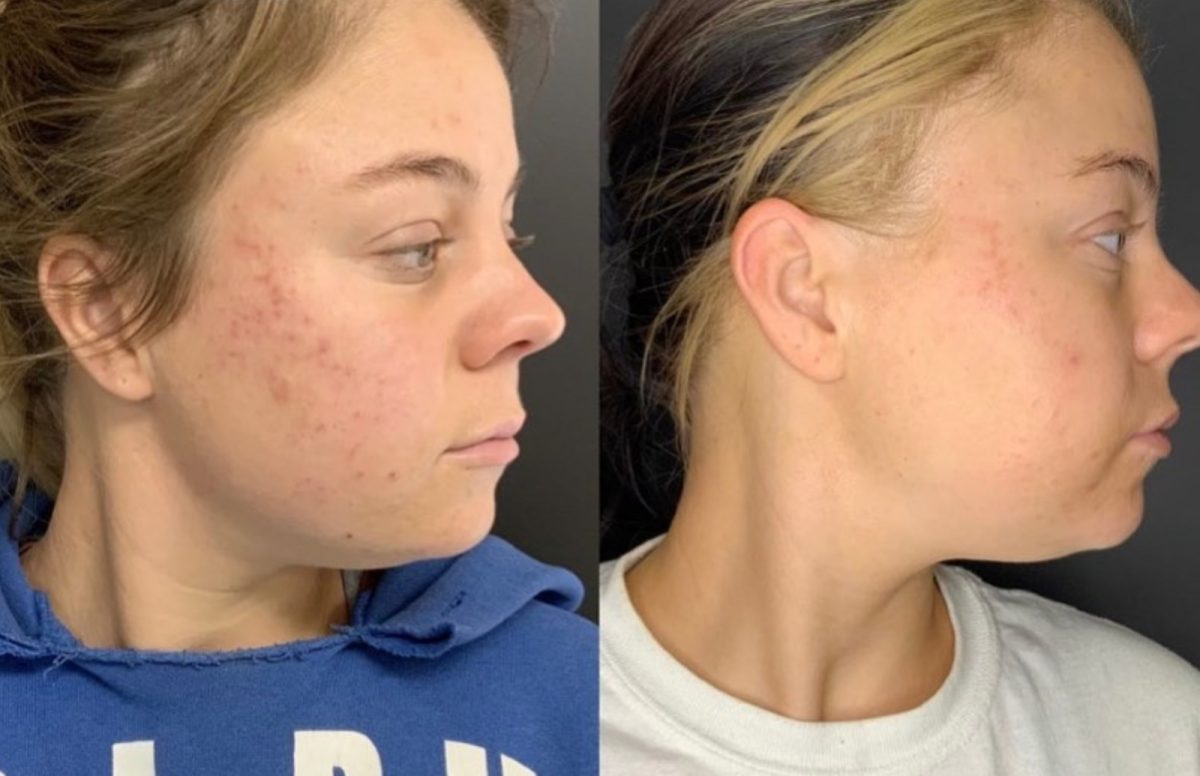 Microneedling and Cool Peel (CO2): before and after, Skincare & Acne at Chin Up Aesthetics