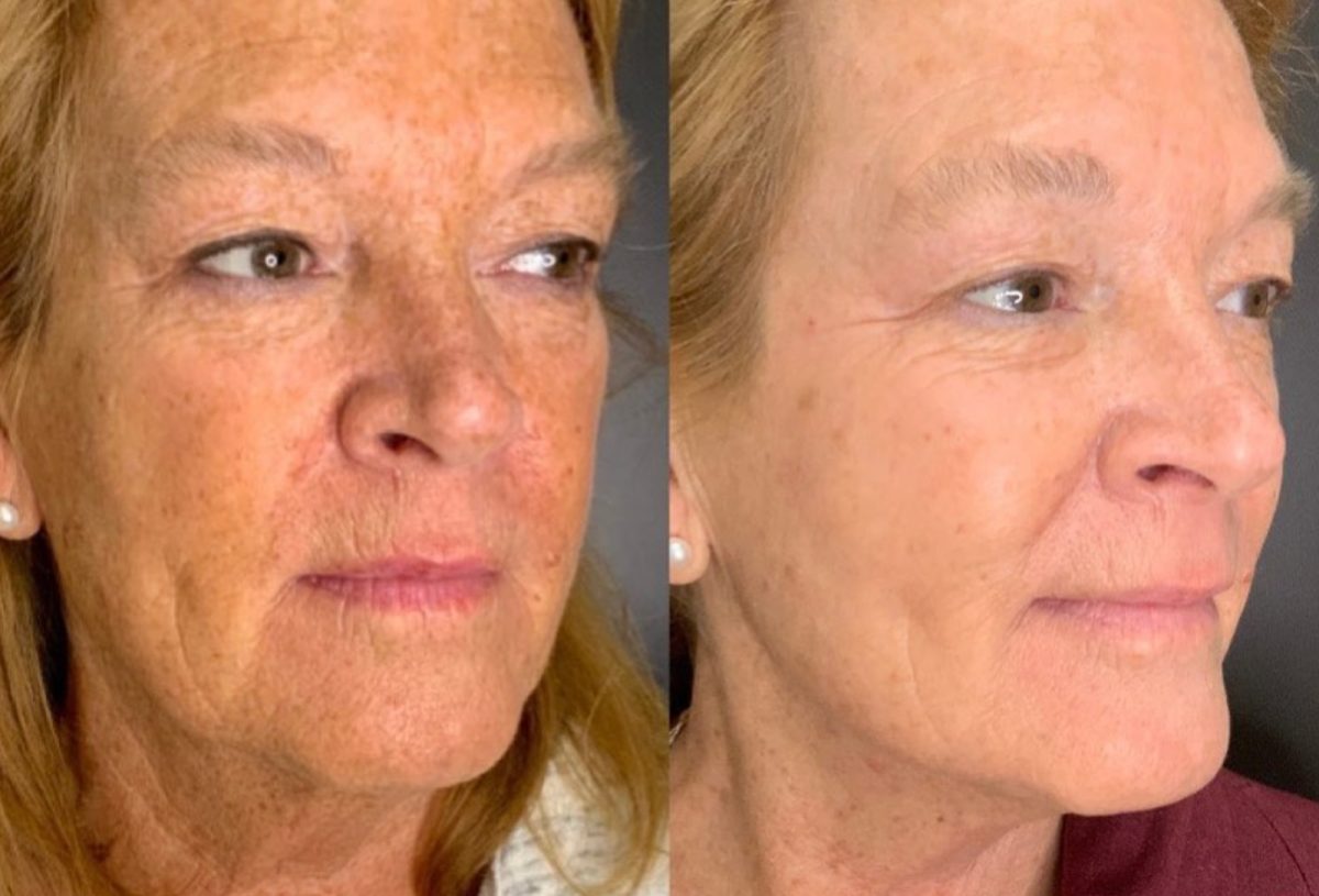 RF Microneedling and Cool Peel (CO2): before and after, Skincare & Acne at Chin Up Aesthetics