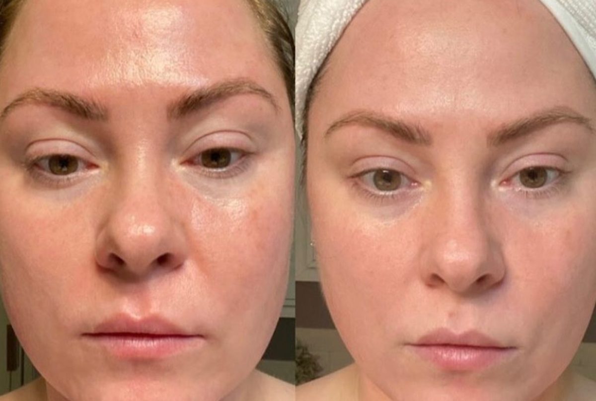 RF Microneedling and Cool Peel (CO2): before and after, Skincare & Acne at Chin Up Aesthetics