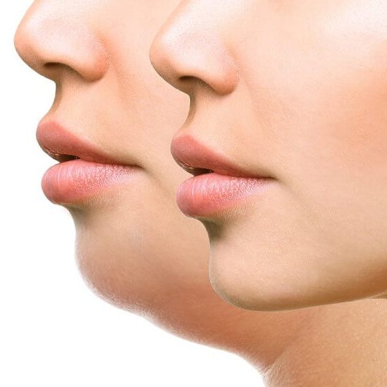 Side-by-side comparison of two female profiles, highlighting the differences before and after a cosmetic procedure at the best medical spa near me. The left profile shows a fuller chin and jawline, while the right profile showcases a more contoured and defined chin and jawline. Medspa near me