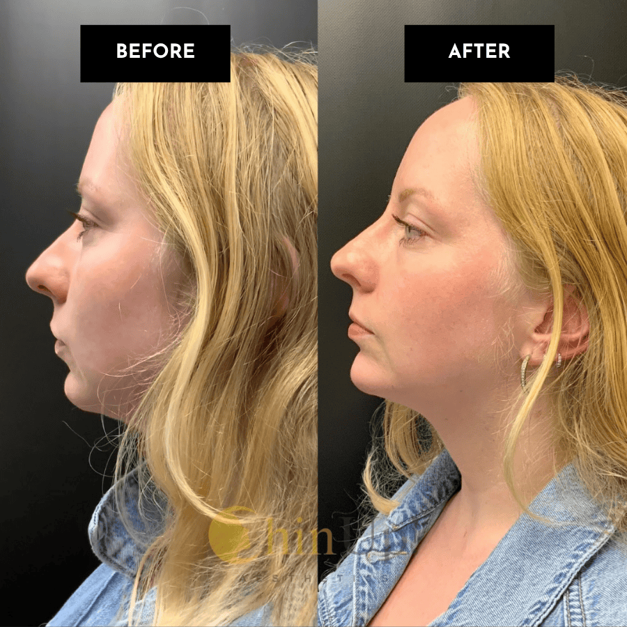 chin filler before and after