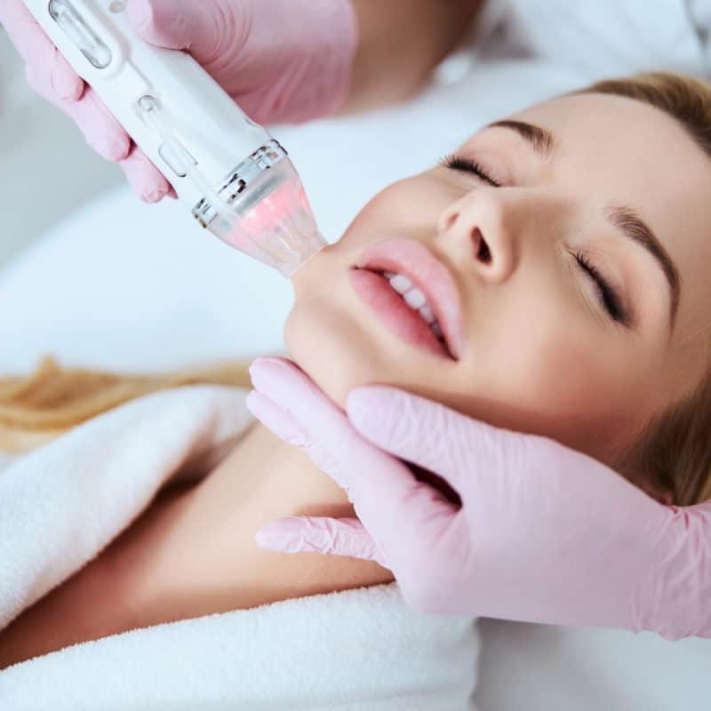 rf microneedling example