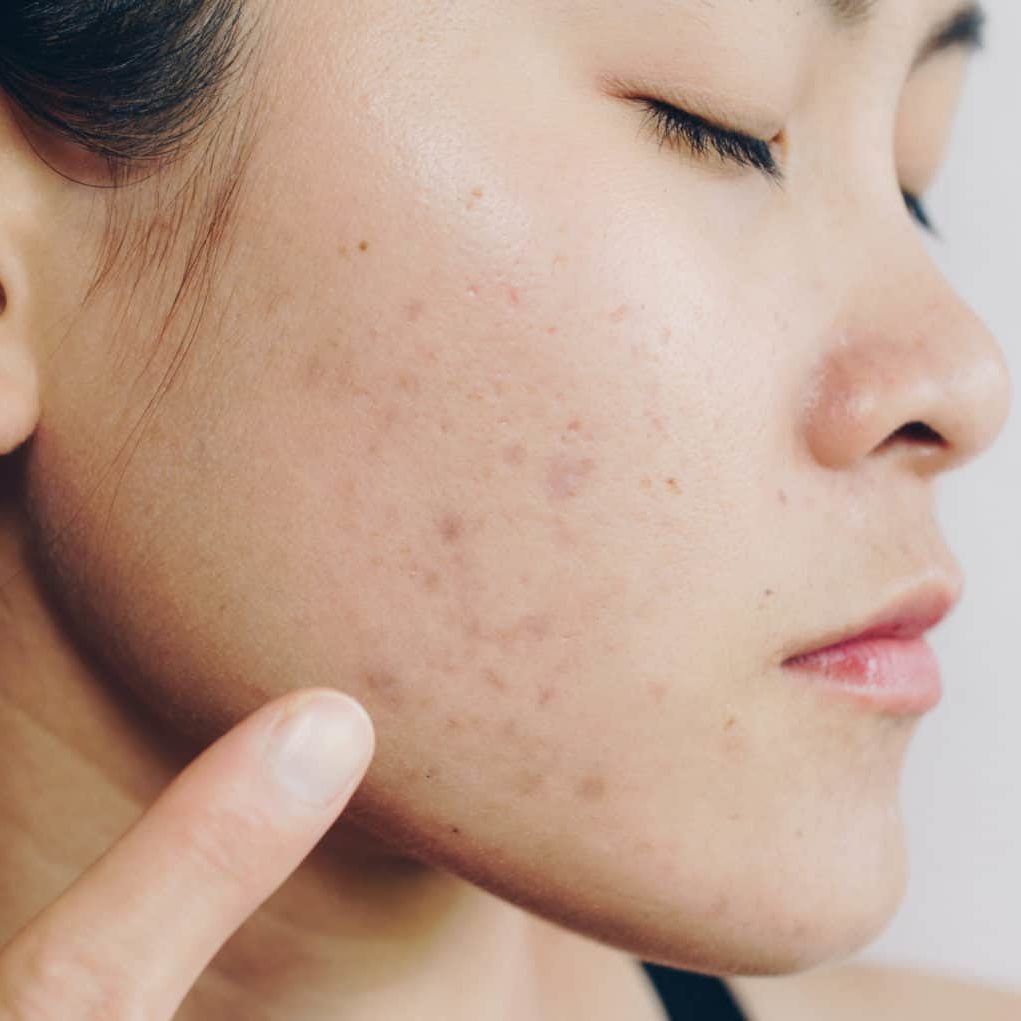 portrait of asian woman has problems with skin on her face. problems with acne and scar on the female skin.