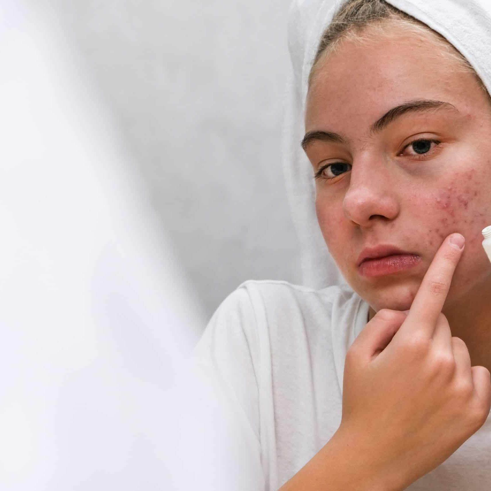 Teenage girl putting on acne cream
